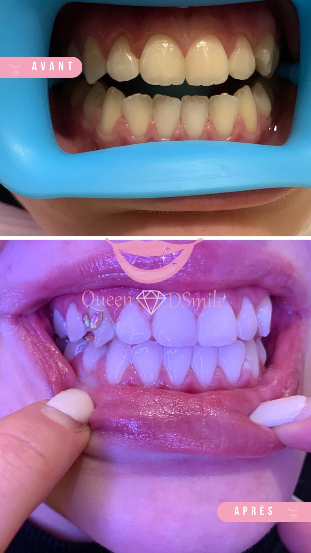 BLANCHIMENT DENTAIRE & STRASS À DOMICILE